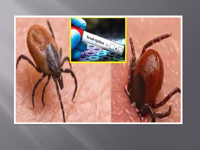 ଡେଙ୍ଗୁ ମାଡୁଛି,ସ୍କ୍ରବ ଟାଇଫସ ଭୟ ବଢୁଛି; ବର୍ଷାଦିନେ ସତର୍କ ରହିବାକୁ ପରାମର୍ଶ