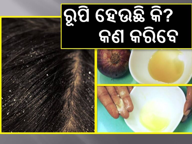 ଶୀତଦିନେ ରୂପି ହେଉଛି କି? କଣ କରିବେ ଜାଣନ୍ତୁ